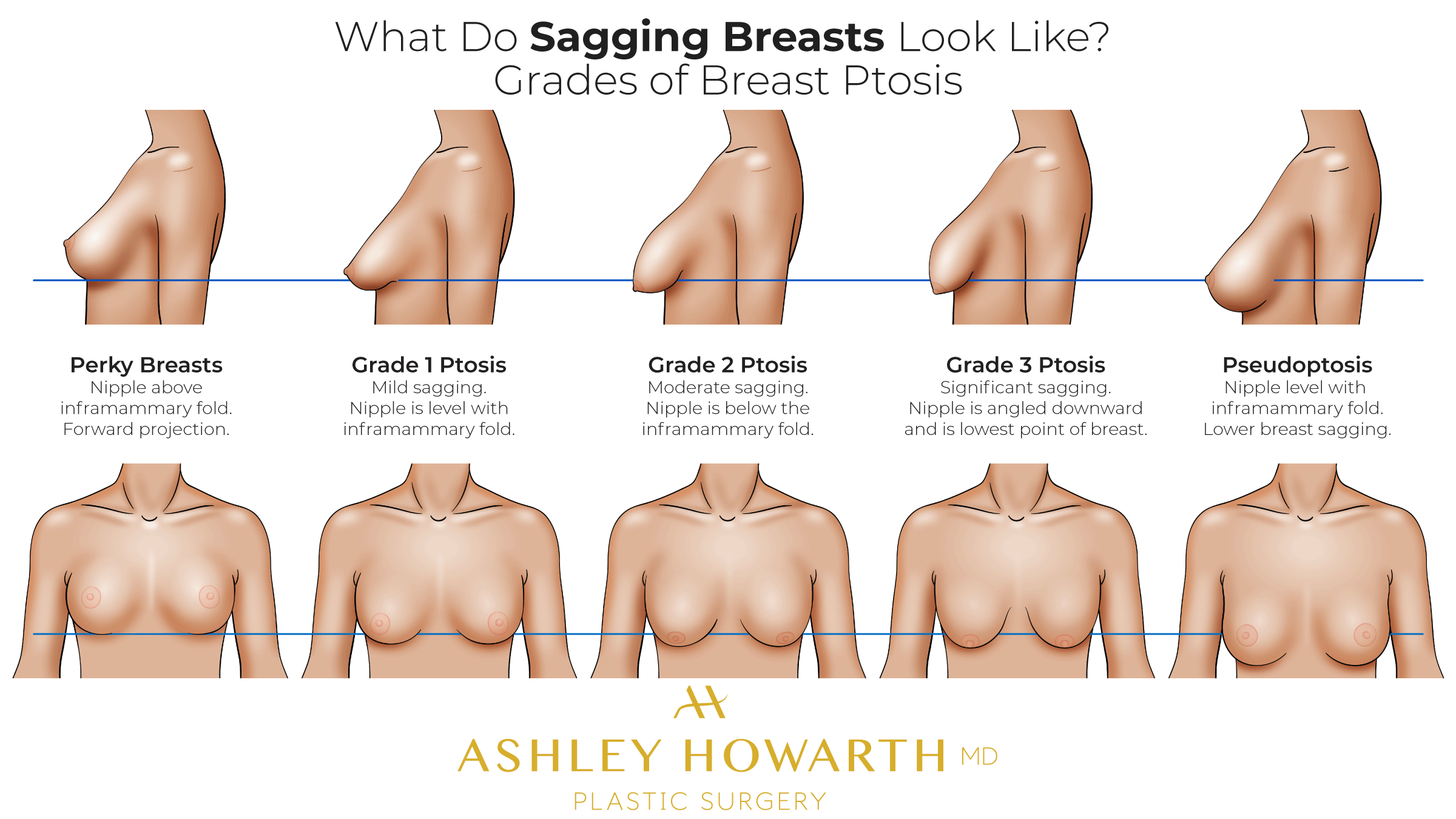carol buege recommends Pictures Of Saggy Breast