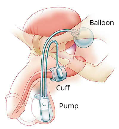 don devitt add pumping air into urethra photo