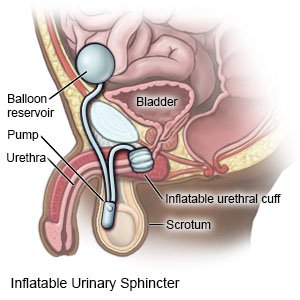cindy lou white recommends pumping air into urethra pic