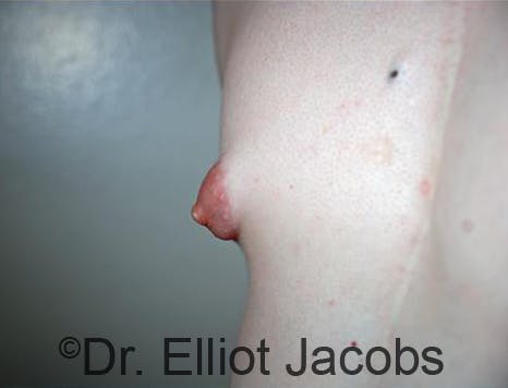 abnormal nipples pics