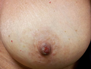 carol martines recommends abnormal nipples pics pic