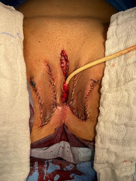 dan georges recommends post op shemale pissing pic