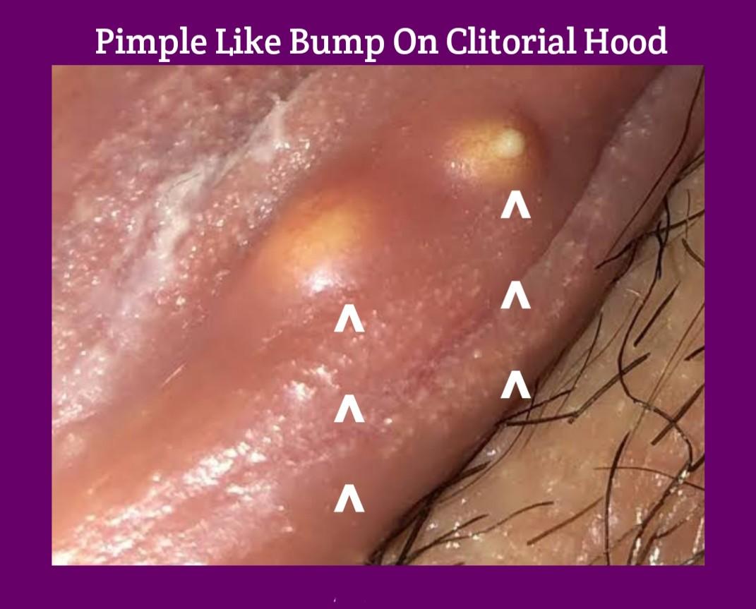 bruno meireles share hard bump on clitorial hood photos